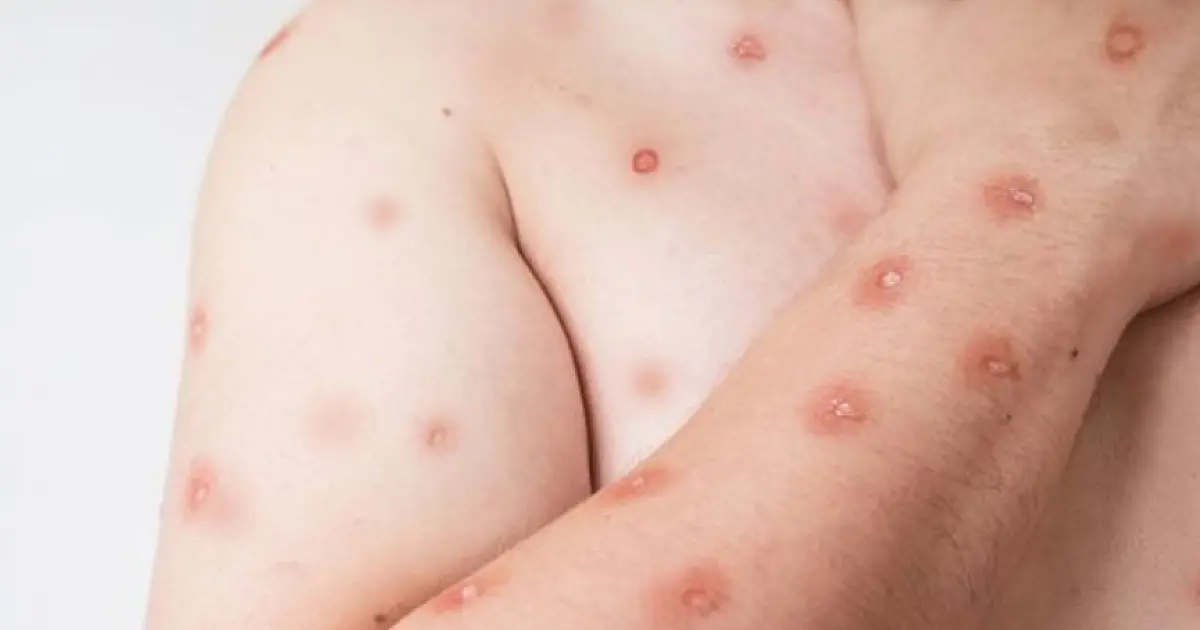 Brasil registra 81 casos de MPOX e Corumbá emite alerta preventivo