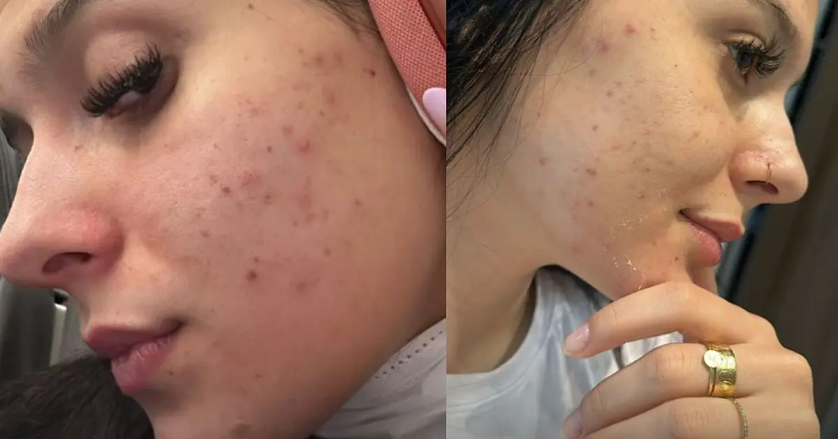 Ana Castela faz desabafo que sofre muito com acne "Eu uso muita maquiagem e como mal"
