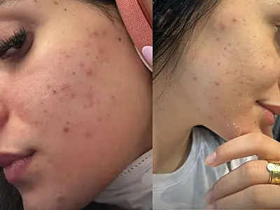 Ana Castela faz desabafo que sofre muito com acne "Eu uso muita maquiagem e como mal"