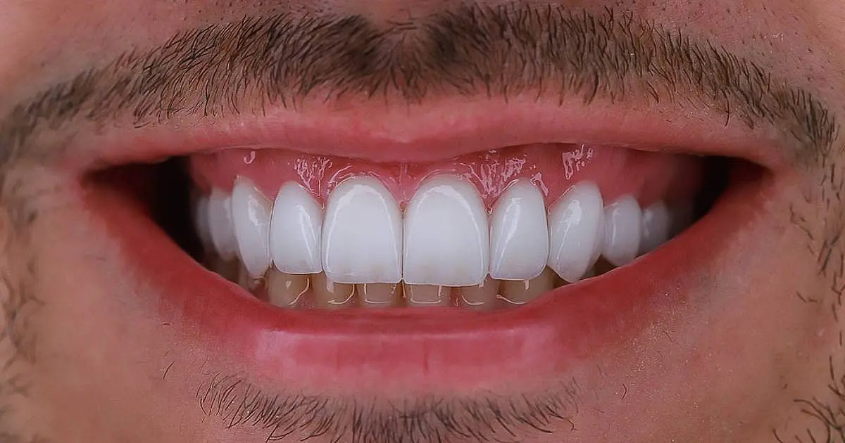 "Lente de contato dental é prótese, é irreversível", alerta cirurgiã-dentista