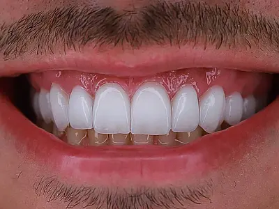 "Lente de contato dental é prótese, é irreversível", alerta cirurgiã-dentista