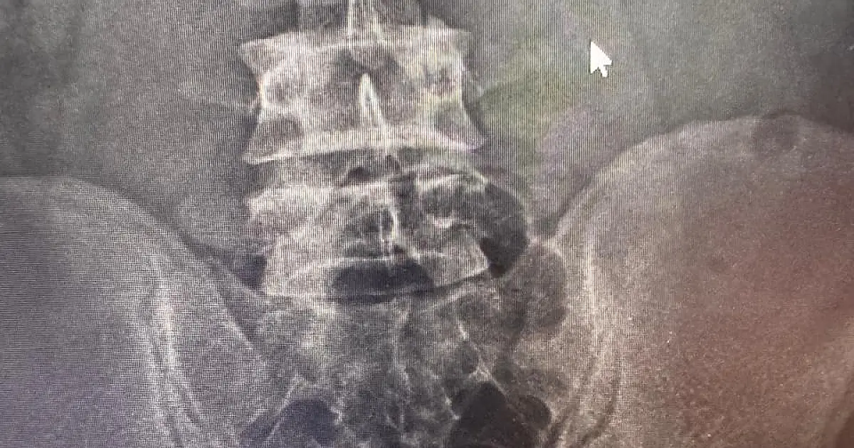 Boliviano é flagrado com cápsulas de cocaína no corpo