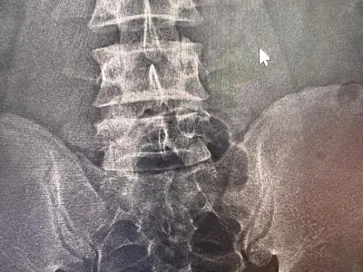 Boliviano é flagrado com cápsulas de cocaína no corpo