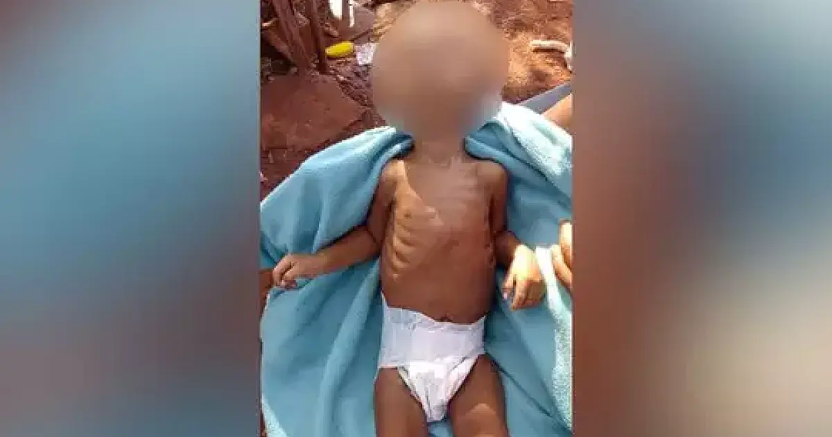 Criança indígena de 1 ano morre vítima de desnutrição em Dourados