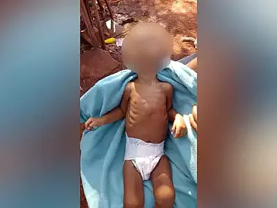Criança indígena de 1 ano morre vítima de desnutrição em Dourados