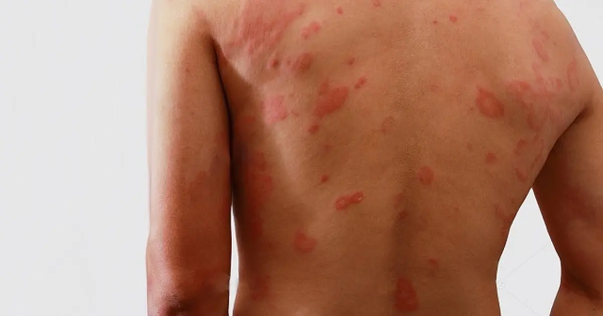 Subnotificação: diagnósticos de hanseníase caíram 62% em MS durante a pandemia