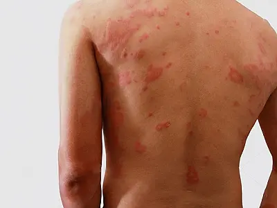 Subnotificação: diagnósticos de hanseníase caíram 62% em MS durante a pandemia