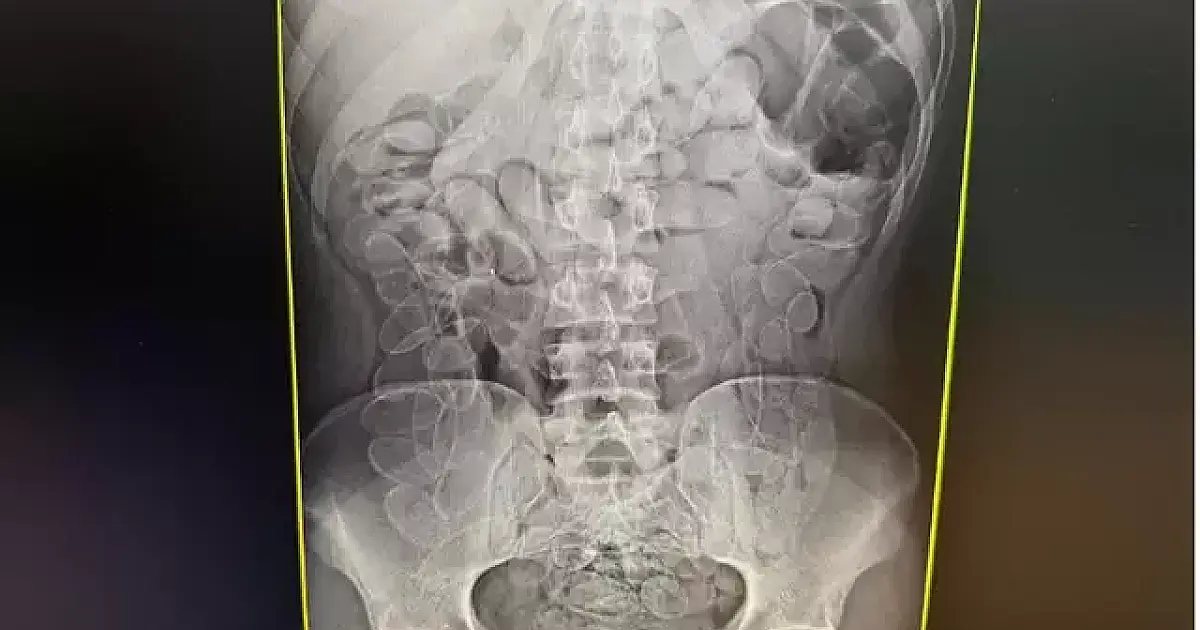 Boliviana é operada após sete dias para retirar 1kg cocaína do estômago