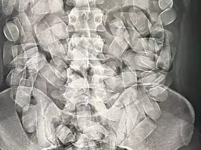 Passageiro é preso no aeroporto de Corumbá com 125 cápsulas de cocaína no estômago